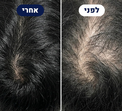לפני ואחרי של לקוח THICKUP, צילום מלמעלה של הראש